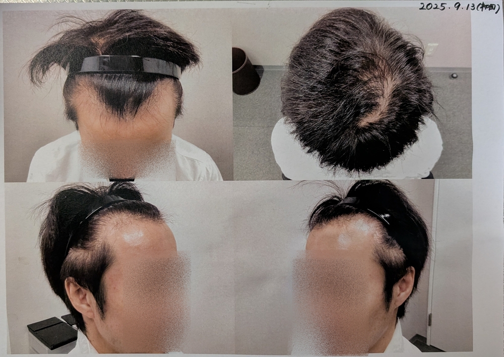 AGA治療前(初回)の頭部写真
